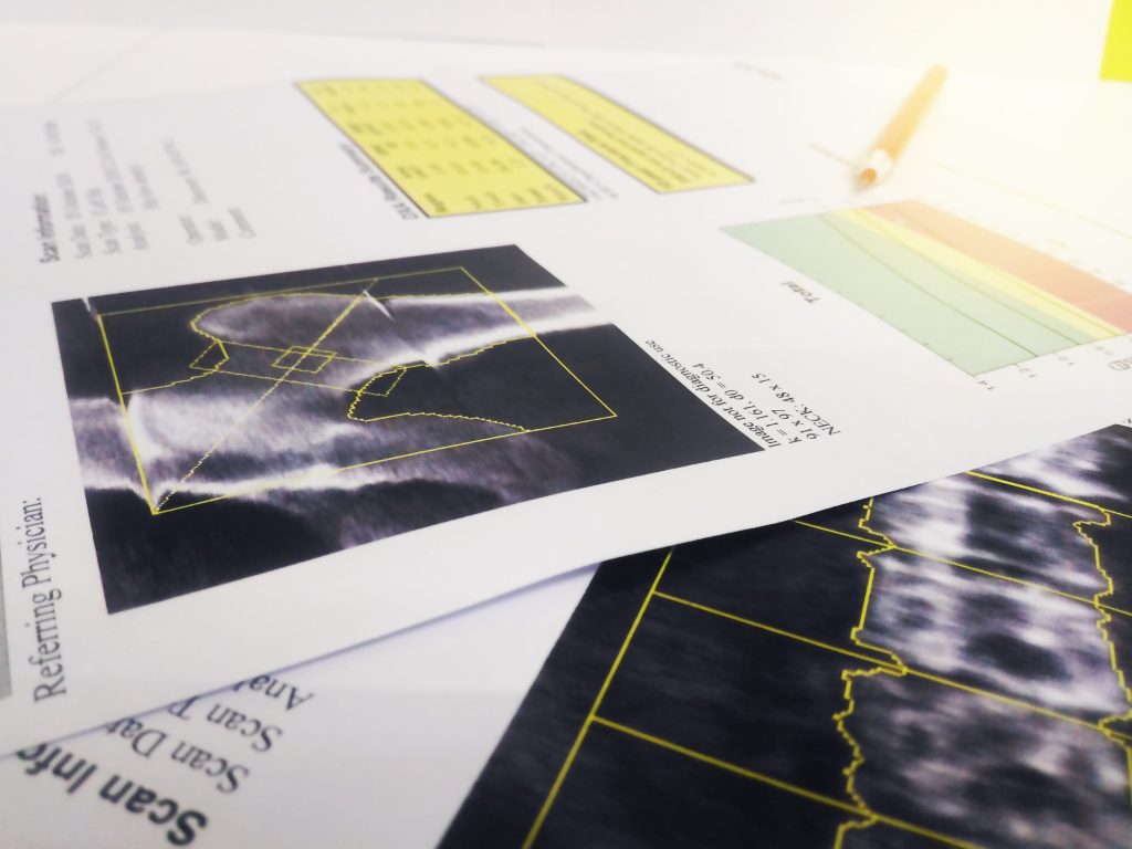What doctors want you to know about GLP-1s and bone loss