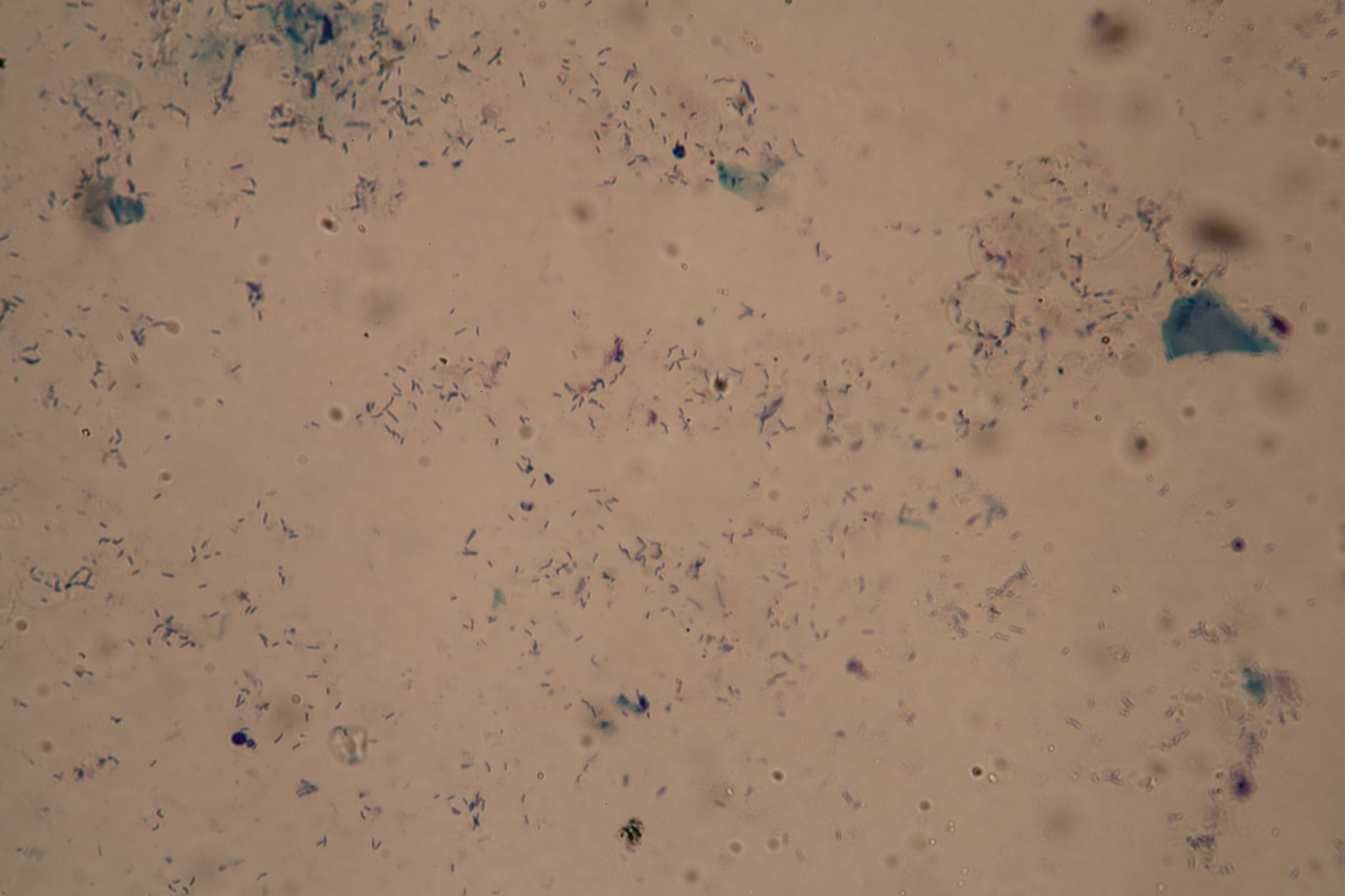 The new TB diagnostic that cou