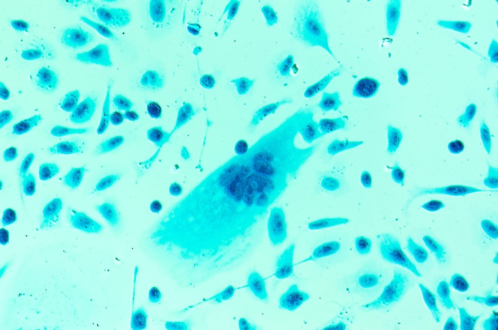 A new drug is producing “stunning” results in men with advanced prostate cancer