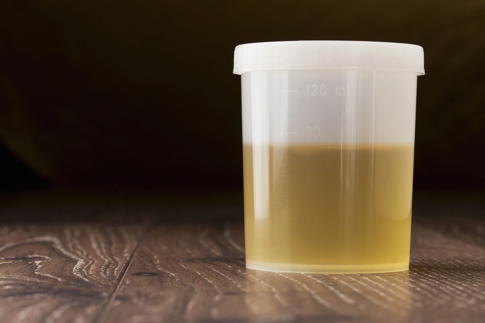 Plastic urine sample cup with white lid on a wooden surface, containing pale yellow urine (medical specimen).