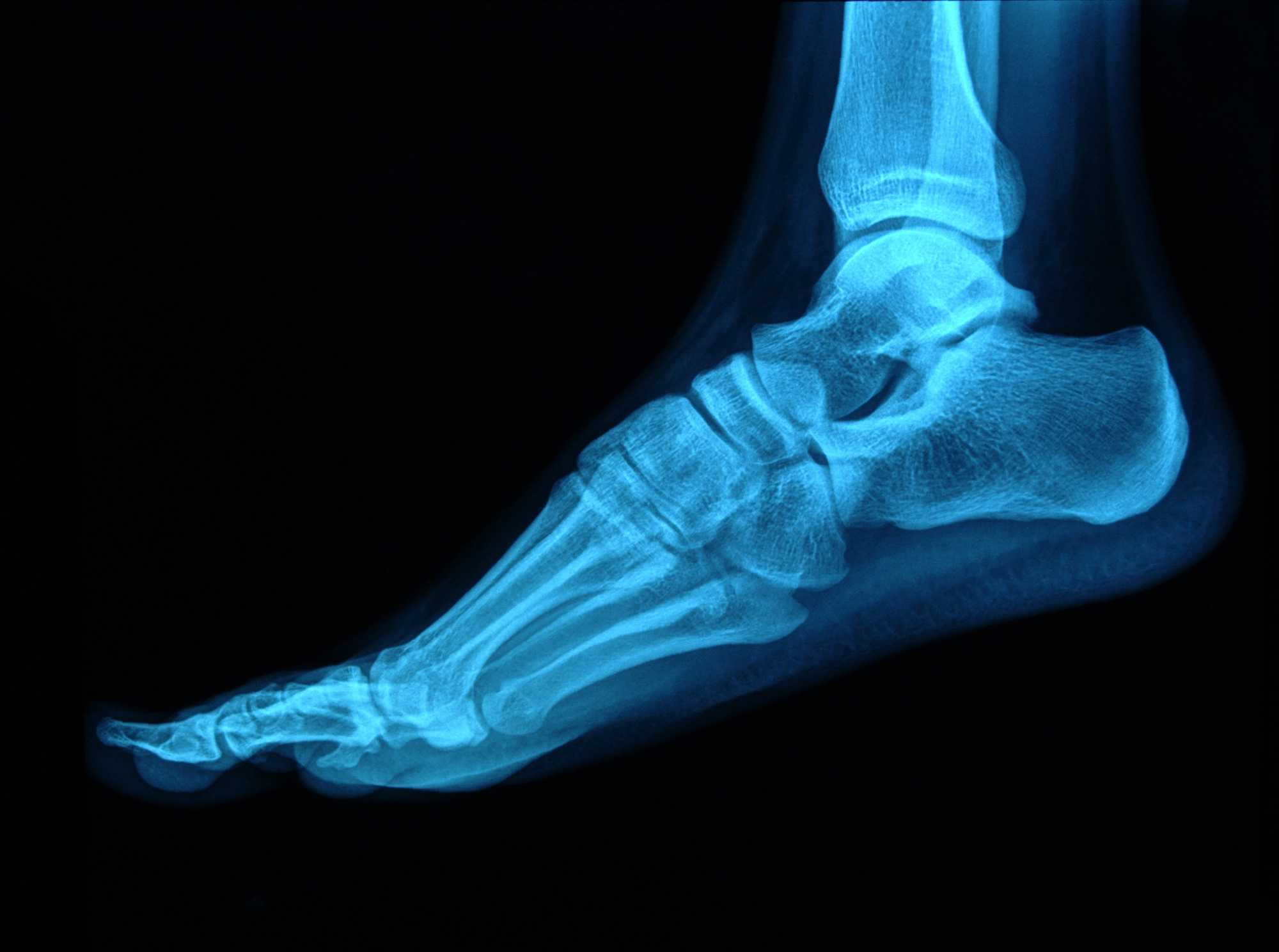 Lateral X-ray of the left foot and ankle showing the calcaneus, talus, and metatarsals from the side.