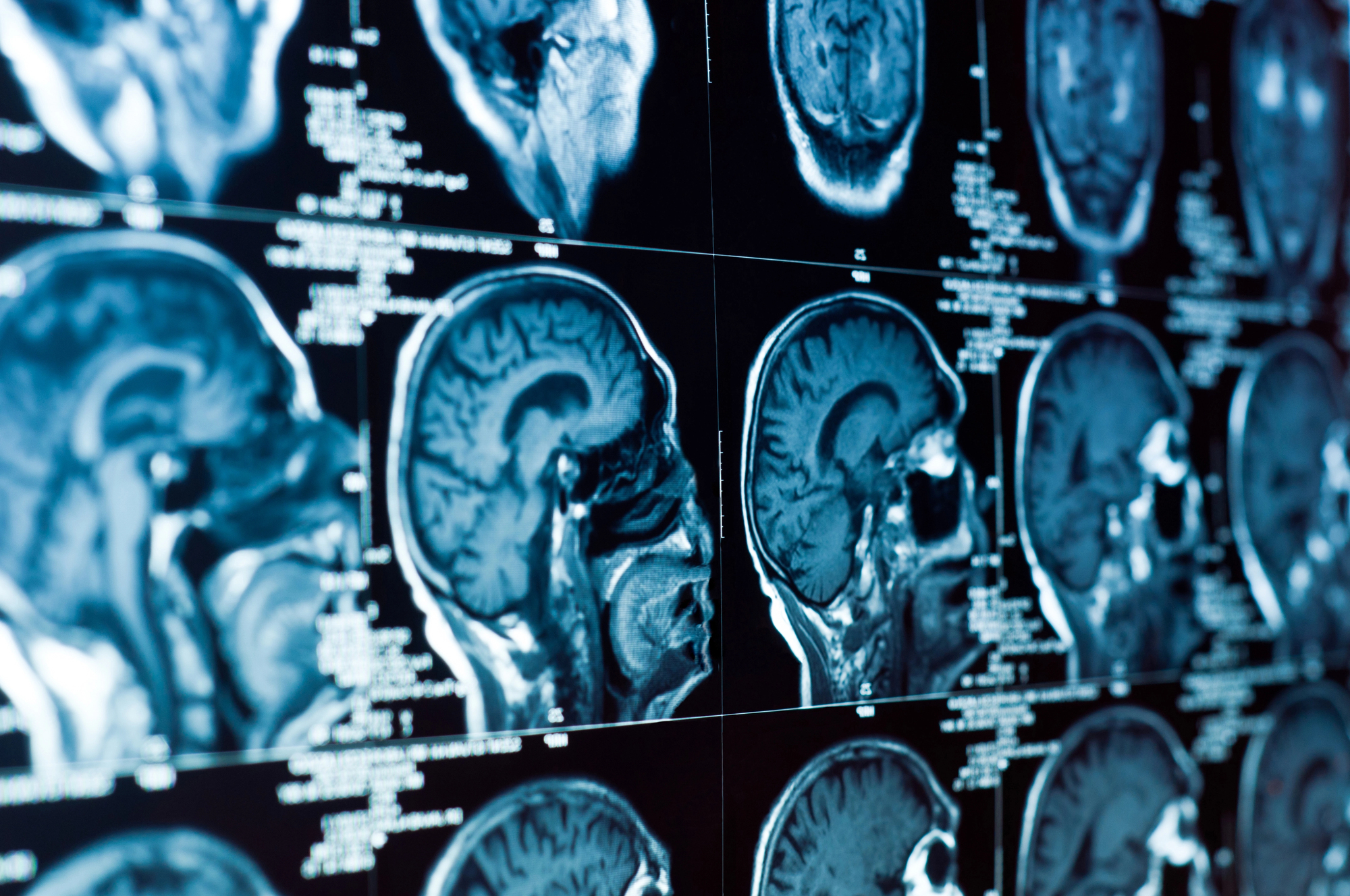 Series of brain MRI slices displayed on a dark monitor, showing sagittal and axial views.