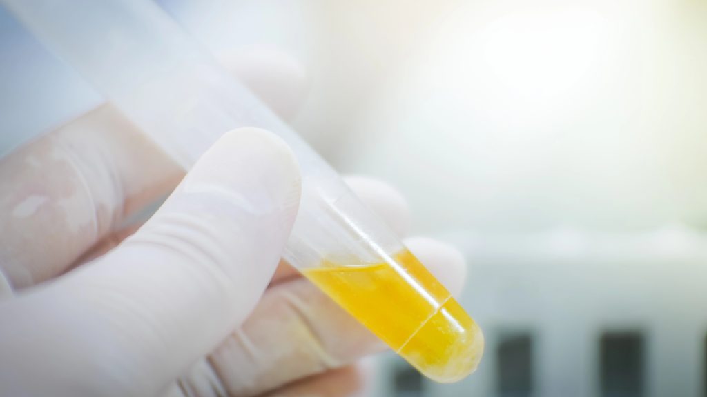 HOME URINE TEST CATCHES BLADDER CANCER 92% OF THE TIME