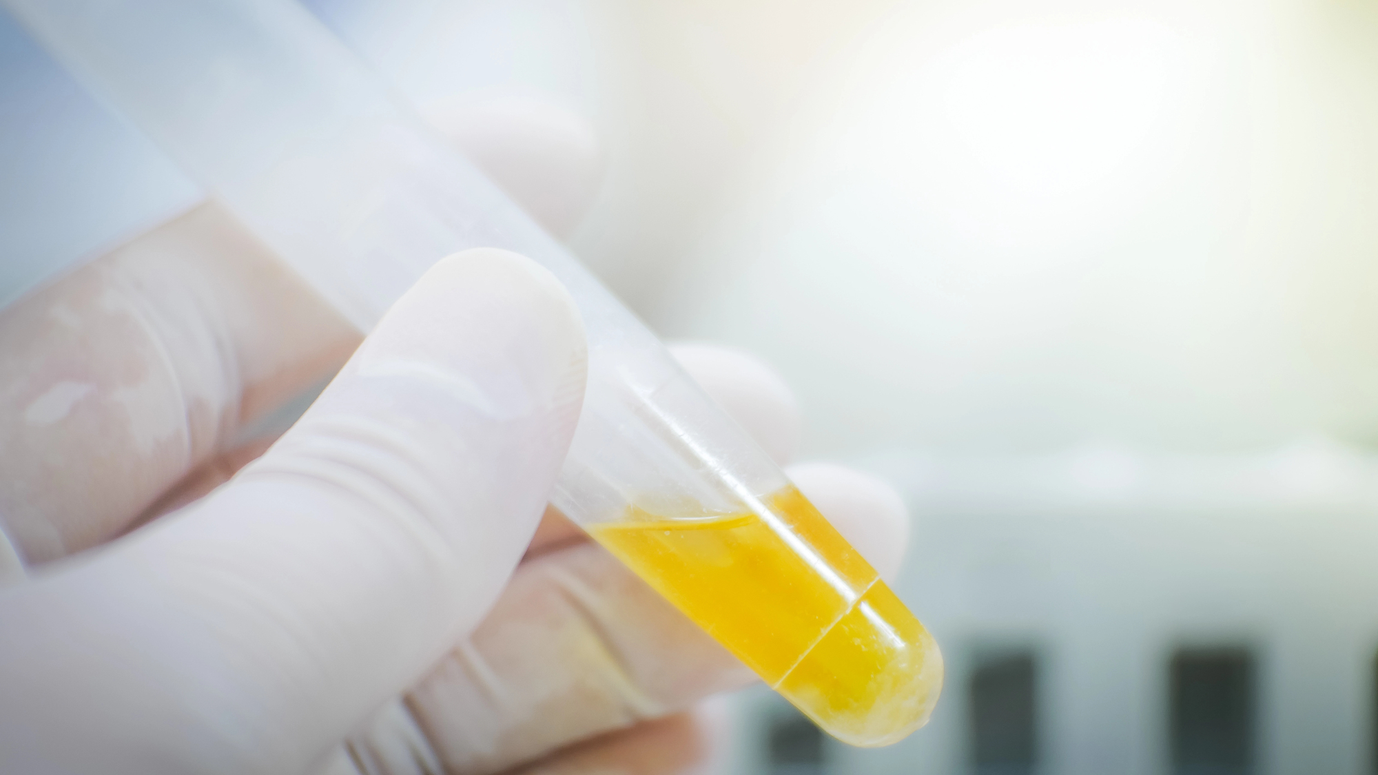 Researcher examining a urine sample for bladder cancer DNA markers in a laboratory