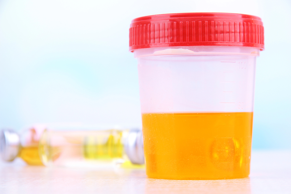 Plastic urine sample cup with a red screw-on lid, half-filled with yellow-orange urine on a table.