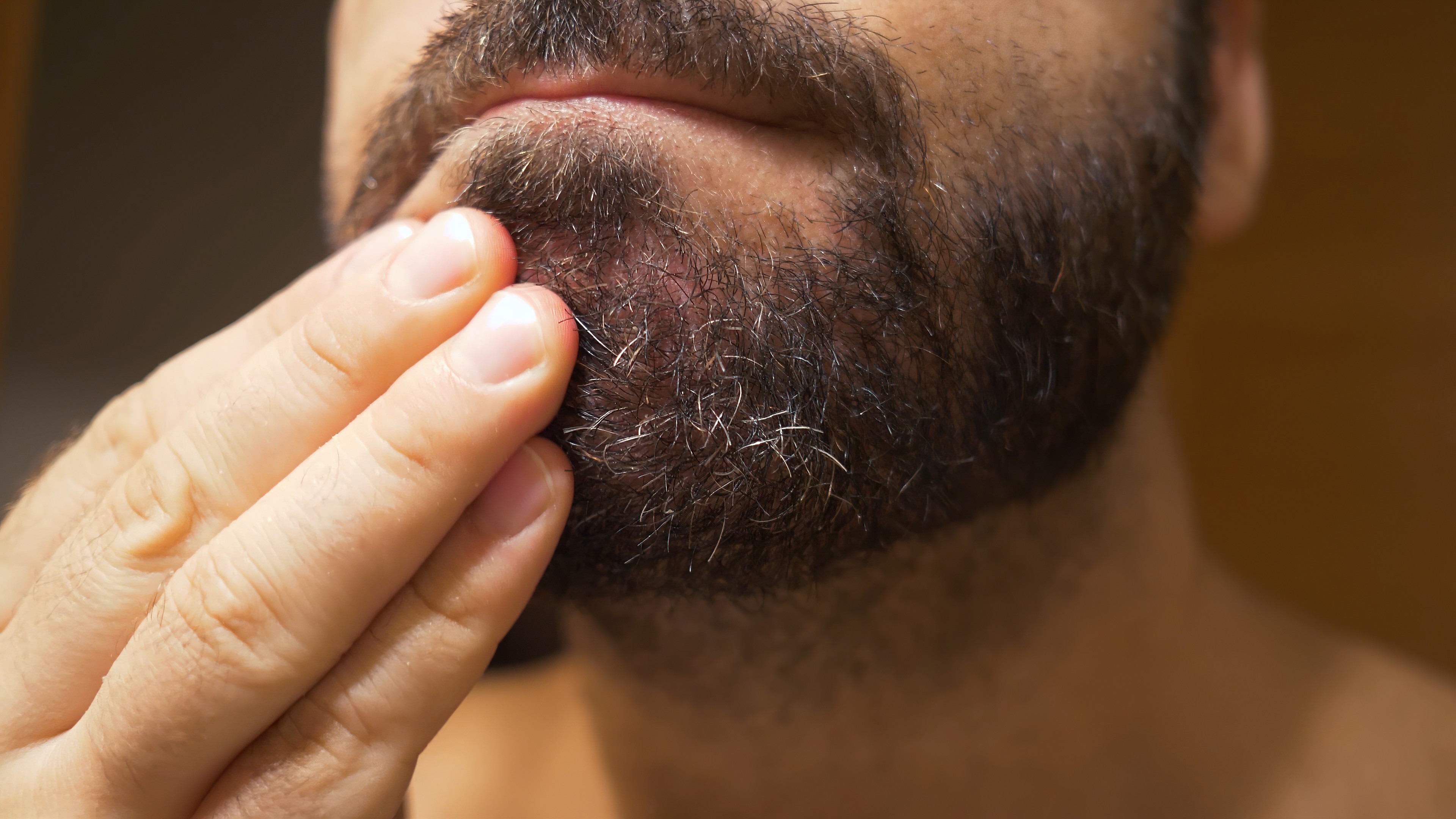 Beard dandruff remedies dermatologists swear by