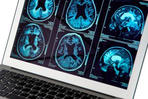 MRI brain scans displayed on a laptop screen, showing multiple axial views in blue-tinted images.
