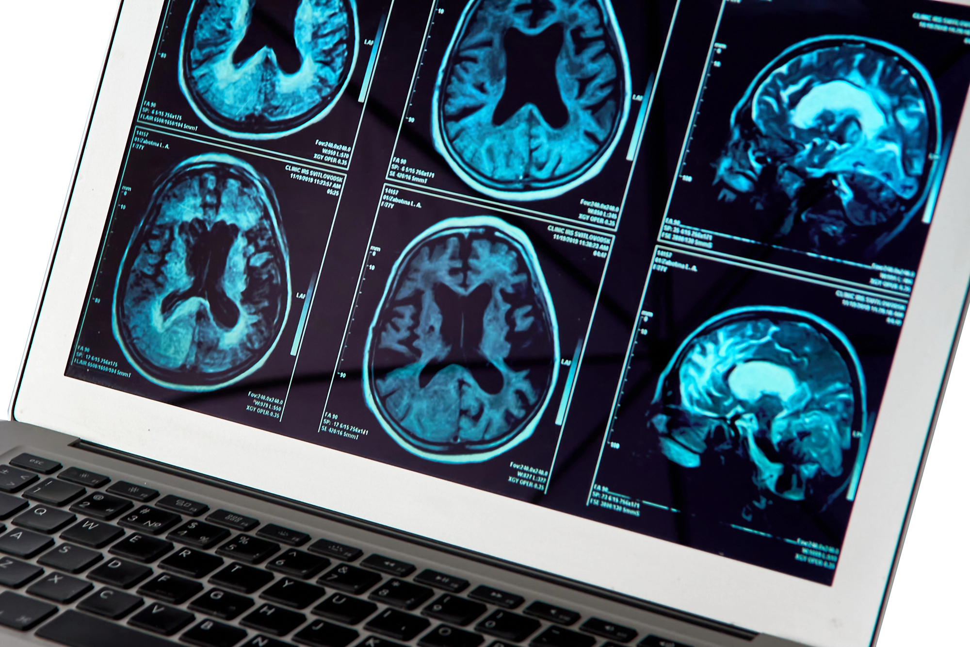 MRI brain scans displayed on a laptop screen, showing multiple axial views in blue-tinted images.