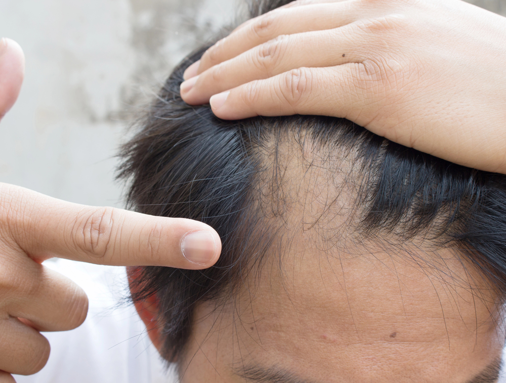 Close-up of a person pulling back hair to show the hairline, suggesting examination of hair loss at the temple area
