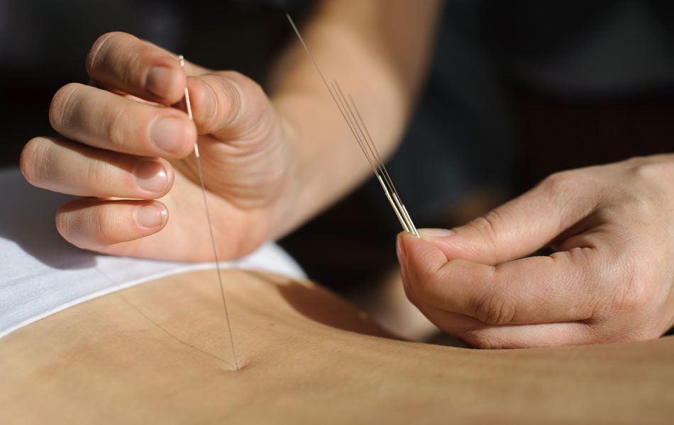 Acupuncture for nasal allergie