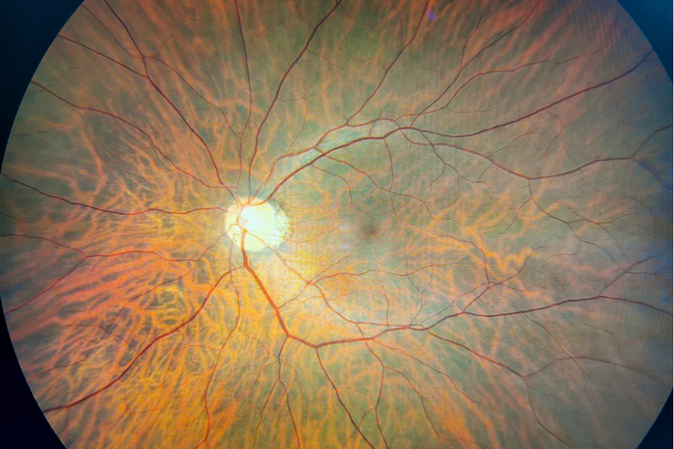 Photograph of Close Look at Retina of the Eye