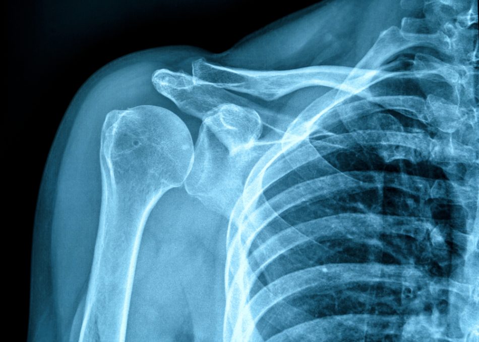 x-ray of shoulder area