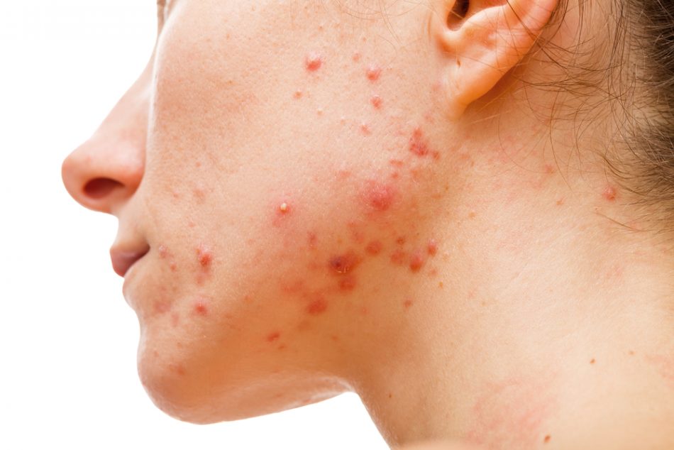 Acne skin because the disorders of sebaceous glands productions.