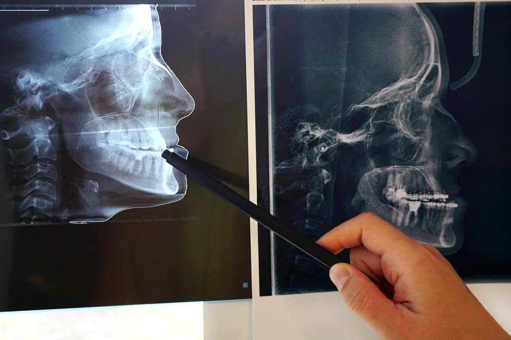 CT scans of a jaw with a black pen being held up to point at it.