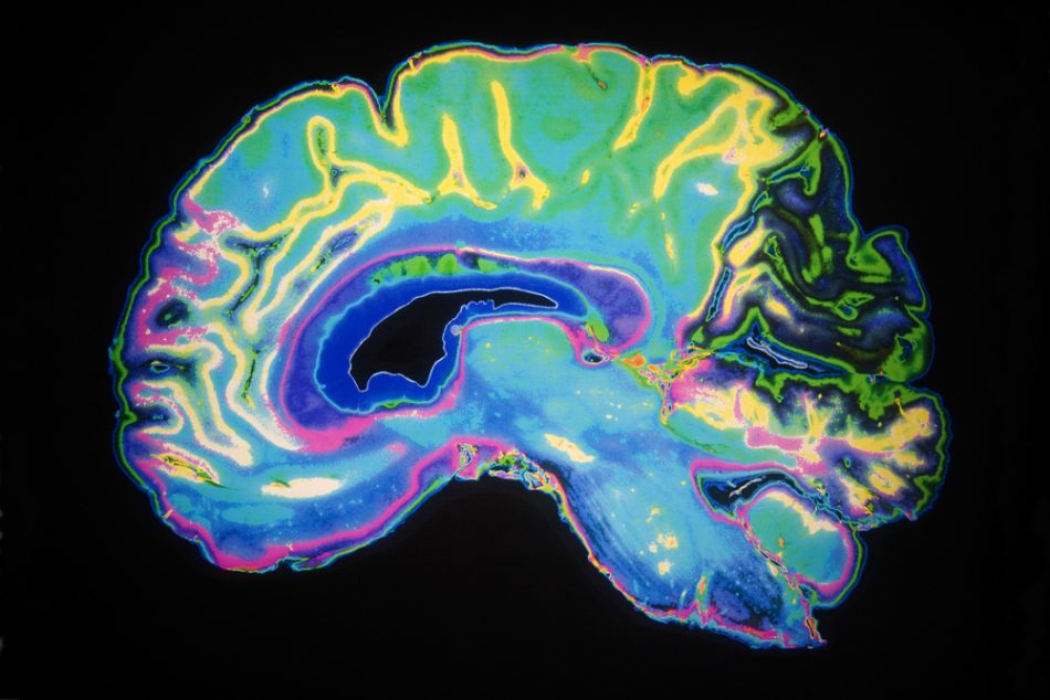 Artificially colored MRI ccan Of human brain.
