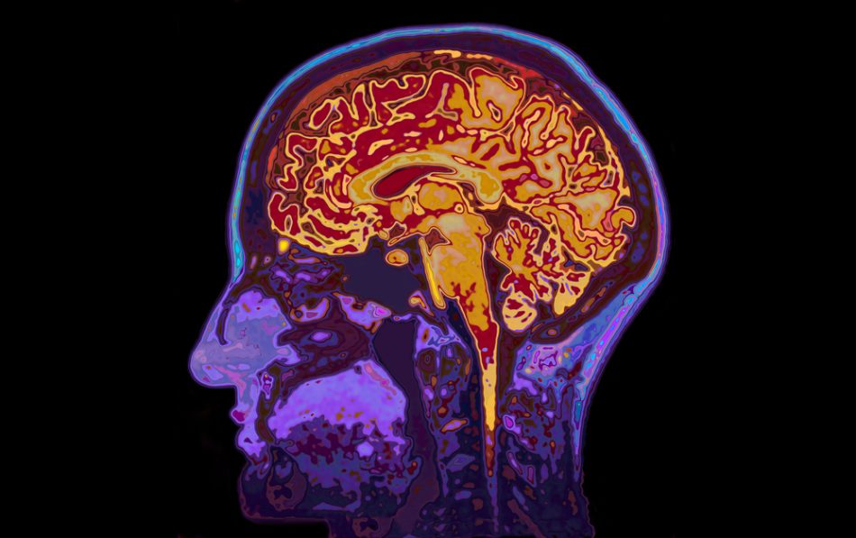 MRI image of head showing brain.