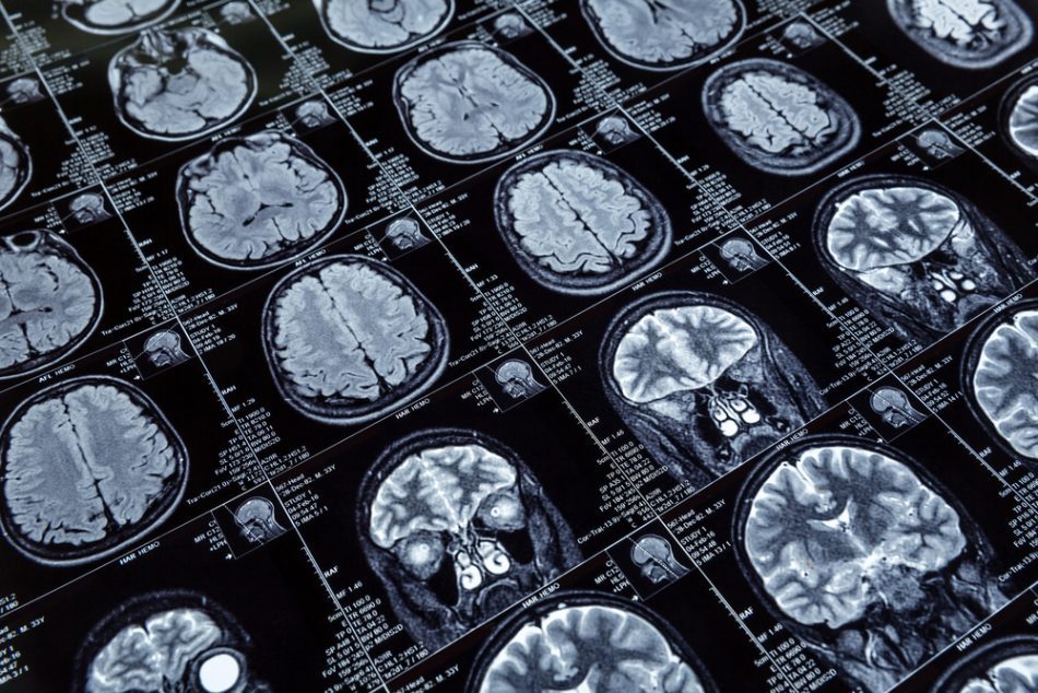 MRI imaging of brains.