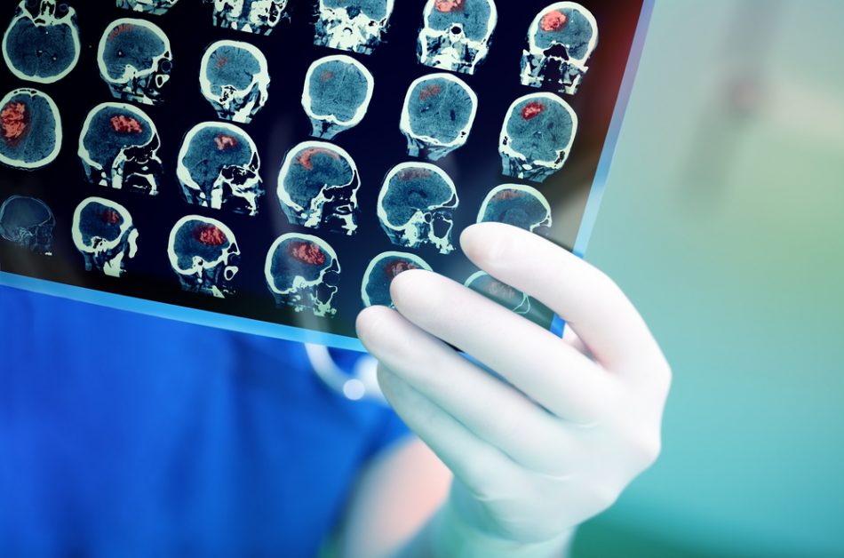 AI can diagnose brain tumours 