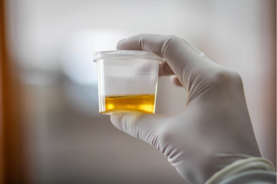 Urine tests could accurately d