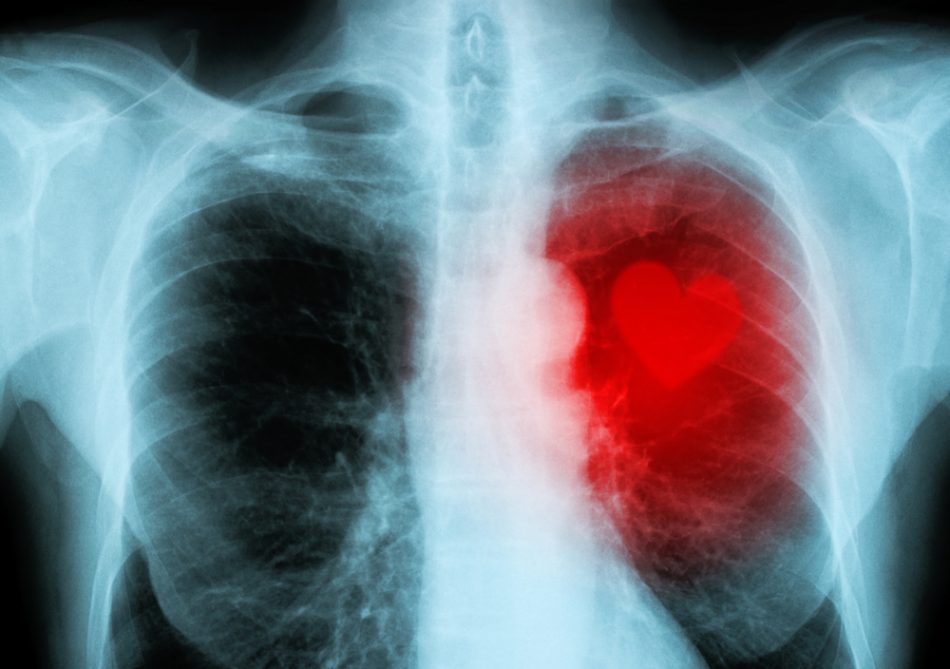 X-ray red heart of human with photoshopped heart shaped outline.