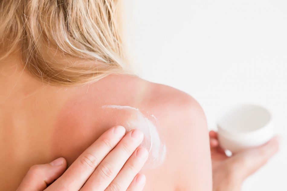 view of sunburnt woman's back as someone rubs soothing cream into shoulder